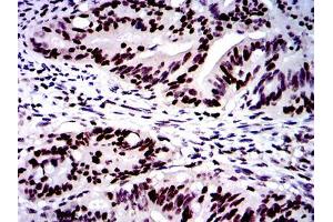 Immunohistochemical analysis of paraffin-embedded rectum cancer tissues using MSH6 mouse mAb with DAB staining.