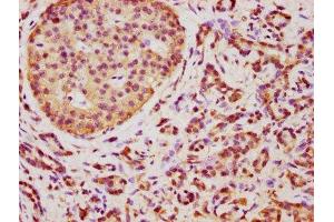 IHC image of ABIN7173067 diluted at 1:350 and staining in paraffin-embedded human pancreatic cancer performed on a Leica BondTM system. (TMEM14A anticorps  (AA 45-78))