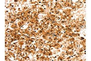 The image on the left is immunohistochemistry of paraffin-embedded Human prostate cancer tissue using ABIN7192494(SLC44A2 Antibody) at dilution 1/20, on the right is treated with synthetic peptide. (SLC44A2 anticorps)