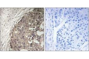 Immunohistochemistry analysis of paraffin-embedded human breast carcinoma tissue, using CSGALNACT1 Antibody. (CSGALNACT1 anticorps  (AA 201-250))