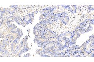 Detection of CAM in Human Colorectal cancer Tissue using Polyclonal Antibody to Calmodulin (CAM) (Calmodulin 1 anticorps  (AA 2-149))