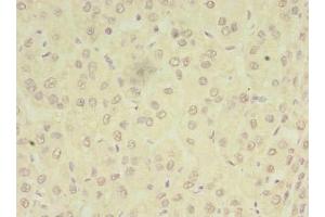 Immunohistochemistry of paraffin-embedded human liver cancer using ABIN7162969 at dilution of 1:100