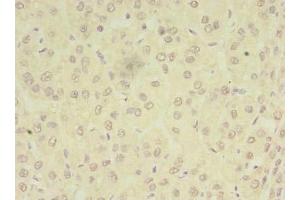 Immunohistochemistry of paraffin-embedded human liver cancer using ABIN7162969 at dilution of 1:100 (PEX11B anticorps  (AA 9-228))
