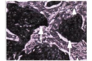 Immunohistochemical staining of paraffin embedded esophageal tumors using Act-MMP9 antibody .