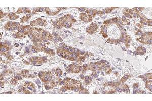 ABIN6272699 at 1/100 staining Human liver cancer tissue by IHC-P. (OR10H5 anticorps  (C-Term))