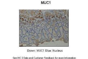 Sample Type :  Human stomach  Primary Antibody Dilution :  1:200  Secondary Antibody :  Anti-rabbit-HRP  Secondary Antibody Dilution :  1:1000  Color/Signal Descriptions :  Brown: MUC1 Blue: Nucleus  Gene Name :  MUC1  Submitted by :  Dr. (MUC1 anticorps  (Middle Region))