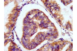 IHC image of ABIN7162786 diluted at 1:200 and staining in paraffin-embedded human endometrial cancer performed on a Leica BondTM system.