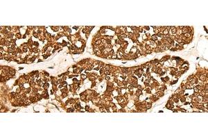 Immunohistochemistry of paraffin-embedded Human esophagus cancer tissue using CALML6 Polyclonal Antibody at dilution of 1:55(x200) (CALML6 anticorps)