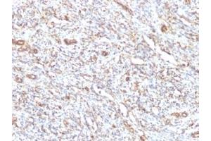 Formalin-fixed, paraffin-embedded human Rhabdomyosarcoma stained with anti-Vimentin antibody.