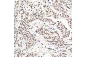 Immunohistochemistry of paraffin-embedded human breast cancer using [KO Validated] L3MBTL3 Rabbit pAb (ABIN6132145, ABIN6143061, ABIN6143062 and ABIN6223119) at dilution of 1:50 (40x lens). (L3MBTL3 anticorps  (AA 1-230))