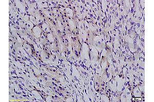 Formalin-fixed and paraffin embedded human colon carcinoma labeled with Anti-TBL1X Polyclonal Antibody, Unconjugated (ABIN705416) at 1:200 followed by conjugation to the secondary antibody and DAB staining (TBL1Y anticorps  (AA 501-577))