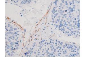 ABIN6267485 at 1/200 staining Human liver cancer tissue sections by IHC-P.