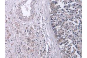 IHC-P analysis of Human Prostate Gland Cancer Tissue, with DAB staining. (Retinoic Acid Receptor beta anticorps  (AA 205-451))
