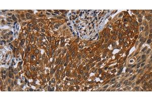 Immunohistochemistry of paraffin-embedded Human cervical cancer tissue using UHRF2 Polyclonal Antibody at dilution 1:40 (UHRF2 anticorps)