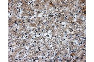 Immunohistochemical staining of paraffin-embedded Carcinoma of liver tissue using anti-SIL1 mouse monoclonal antibody. (SIL1 anticorps)