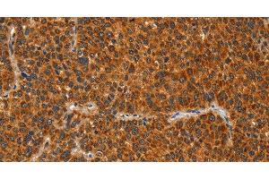Immunohistochemistry of paraffin-embedded Human liver cancer tissue using IKZF3 Polyclonal Antibody at dilution 1:60 (IKZF3 anticorps)