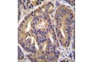 Immunohistochemistry analysis in formalin fixed and paraffin embedded human prostate carcinoma reacted with GTF2H2C Antibody (C-term) followed by peroxidase conjugation of the secondary antibody and DAB staining. (GTF2H2C anticorps  (C-Term))