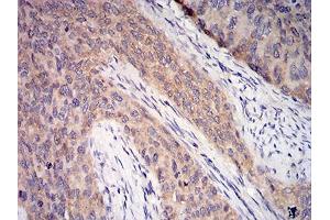 Immunohistochemical analysis of paraffin-embedded cervical cancer tissues using C1QA mouse mAb with DAB staining.