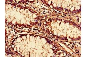 Immunohistochemistry of paraffin-embedded human colon cancer using ABIN7170624 at dilution of 1:100 (Pre-mRNA Branch Site Protein p14 (SF3B14) (AA 1-125) anticorps)