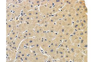 ABIN7096894 and ABIN7100960 at 1/100 staining human liver cancer by IHC-P. (PIGT anticorps)