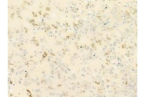 ABIN6264416 and ABIN6279652 at 1/100 staining human melanoma by IHC-P.