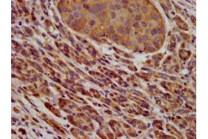 IHC image of ABIN7163609 diluted at 1:600 and staining in paraffin-embedded human pancreatic cancer performed on a Leica BondTM system.