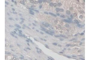 Detection of NOX5 in Human Prostate Tissue using Polyclonal Antibody to Nicotinamide Adenine Dinucleotide Phosphate Oxidase 5 (NOX5)