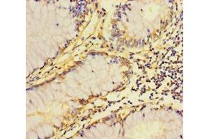 Immunohistochemistry of paraffin-embedded human colon cancer using ABIN7162535 at dilution of 1:100 (ZDHHC15 anticorps  (AA 239-337))