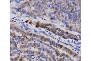 Immunohistochemistry of paraffin-embedded Human thyroid cancer using SNCG Polyclonal Antibody at dilution of 1:200 (40x lens). (SNCG anticorps)