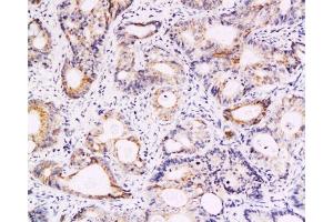 Formalin-fixed and paraffin embedded human colon carcinoma labeled with Anti-Survivin Polyclonal Antibody, Unconjugated  at 1:200, followed by conjugation to the secondary antibody and DAB staining