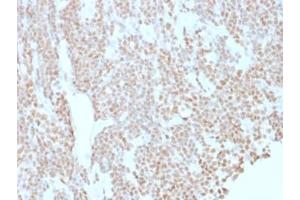 IHC testing of FFPE human lymphoma with Bcl6 antibody (clone BCL6/1527). (BCL6 anticorps  (AA 256-389))