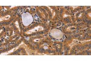 Immunohistochemistry of paraffin-embedded Human thyroid cancer tissue using CCL23 Polyclonal Antibody at dilution 1:50 (CCL23 anticorps)
