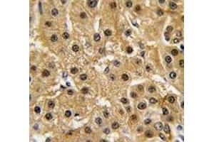 IHC analysis of FFPE human hepatocarcinoma tissue stained with c-Abl antibody (ABL1 anticorps  (AA 741-769))