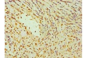 Immunohistochemistry of paraffin-embedded human breast cancer using ABIN7142266 at dilution of 1:100 (DAP3 anticorps  (AA 159-398))