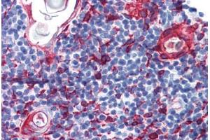 Human Thymus (formalin-fixed, paraffin-embedded) stained with KRT13 antibody ABIN364278 at 10 ug/ml followed by biotinylated anti-mouse IgG secondary antibody ABIN481714, alkaline phosphatase-streptavidin and chromogen. (Cytokeratin 13 anticorps)