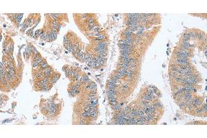 Immunohistochemistry of paraffin-embedded Human colon cancer tissue using PARD6A Polyclonal Antibody at dilution 1:60 (PARD6A anticorps)