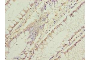 Immunohistochemistry of paraffin-embedded human colon cancer using ABIN7174715 at dilution of 1:100 (C11orf53 anticorps  (AA 13-236))