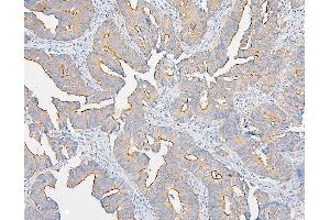 IHC analysis of IQGAP1 using anti-IQGAP1 antibody (ABIN6719262). (IQGAP1 anticorps)
