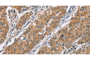 Immunohistochemistry of paraffin-embedded Human gastric cancer using COPB1 Polyclonal Antibody at dilution of 1:50