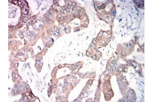 Immunohistochemical analysis of paraffin-embedded rectal cancer tissues using ADAM10 mouse mAb with DAB staining.
