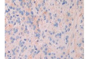 DAB staining on IHC-P; Samples: Human Prostate cancer Tissue (MEPE anticorps  (AA 212-445))