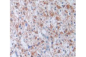 IHC-P analysis of glioma tissue, with DAB staining. (Factor VIII anticorps  (AA 1887-2044))