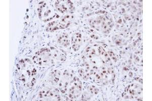 IHC-P Image Immunohistochemical analysis of paraffin-embedded A549 Xenograft, using DNA ligase 3, antibody at 1:100 dilution. (LIG3 anticorps)