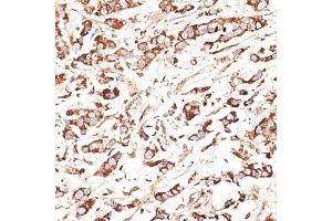 Immunohistochemistry of paraffin-embedded human breast cancer using KLHL9 antibody (ABIN6132083, ABIN6142940, ABIN6142941 and ABIN6214299) at dilution of 1:100 (40x lens). (KLHL9 anticorps  (AA 1-100))