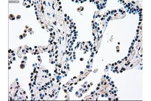 Immunohistochemical staining of paraffin-embedded Adenocarcinoma of breast tissue using anti-MAP2K4 mouse monoclonal antibody. (MAP2K4 anticorps)