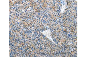 Immunohistochemistry of Human liver cancer using EPHB3 Polyclonal Antibody at dilution of 1:50 (EPH Receptor B3 anticorps)