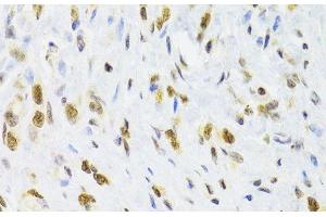 Immunohistochemistry of paraffin-embedded Human gastric cancer using DOK1 Polyclonal Antibody at dilution of 1:100 (40x lens).