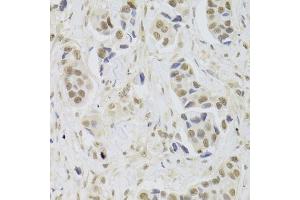 Immunohistochemistry of paraffin-embedded human breast cancer using UBE3C Antibody (ABIN5973842) at dilution of 1/100 (40x lens). (UBE3C anticorps)