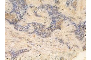 ABIN6261139 and ABIN6266523 at 1/100 staining human breast carcinoma by IHC-P. (Cyclin A1 anticorps  (C-Term))