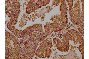 IHC image of ABIN7175790 diluted at 1:100 and staining in paraffin-embedded human endometrial cancer performed on a Leica BondTM system. (WDR73 anticorps  (AA 163-366))